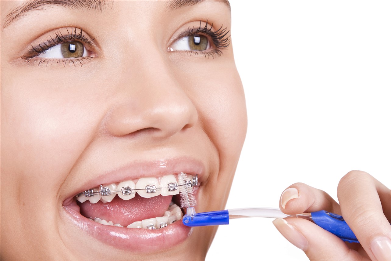 A closeup picture of a teenager wearing orthodontic braces in langford.