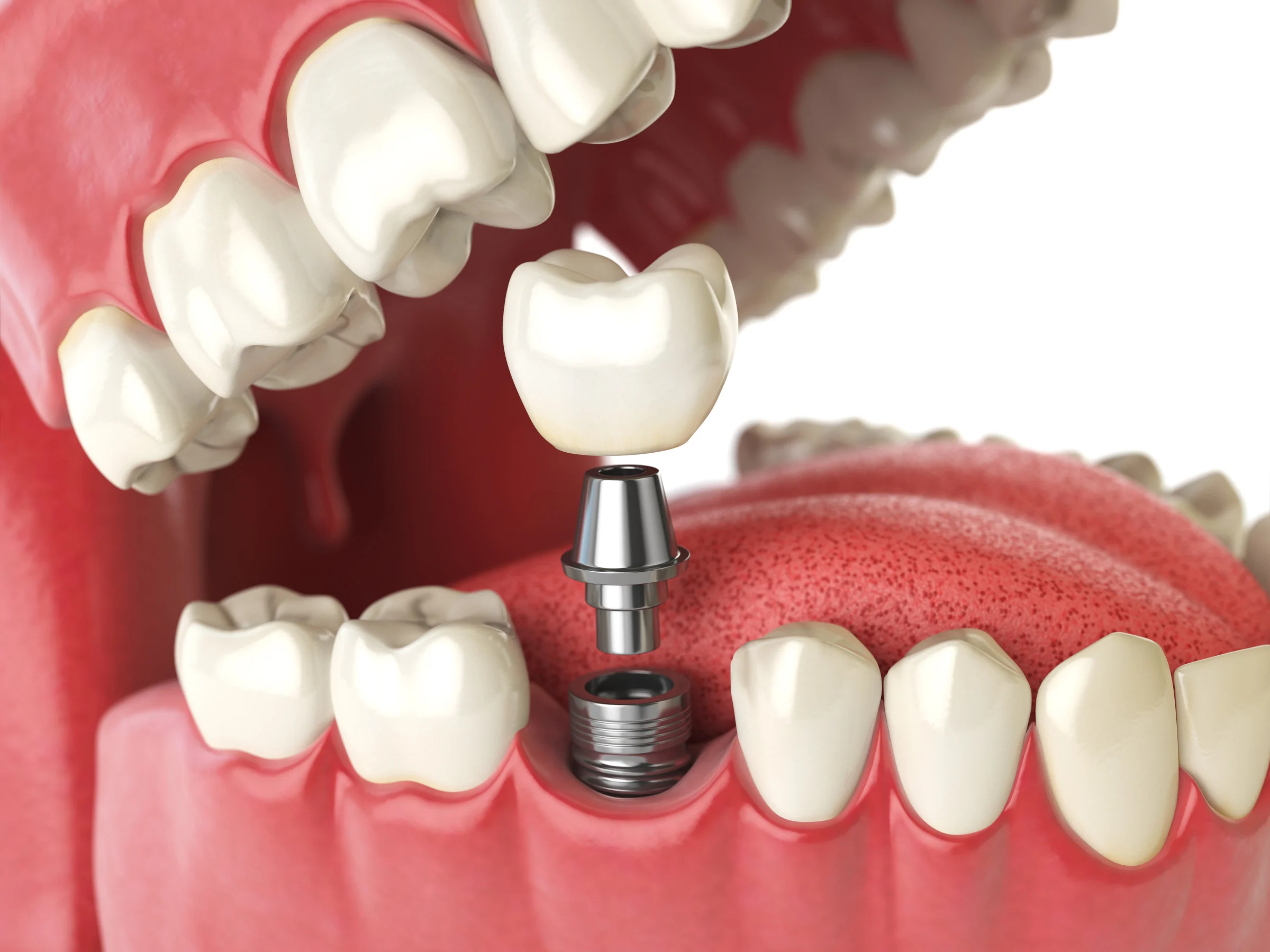 A 3D Medical rendering of a dental implant being put into place.